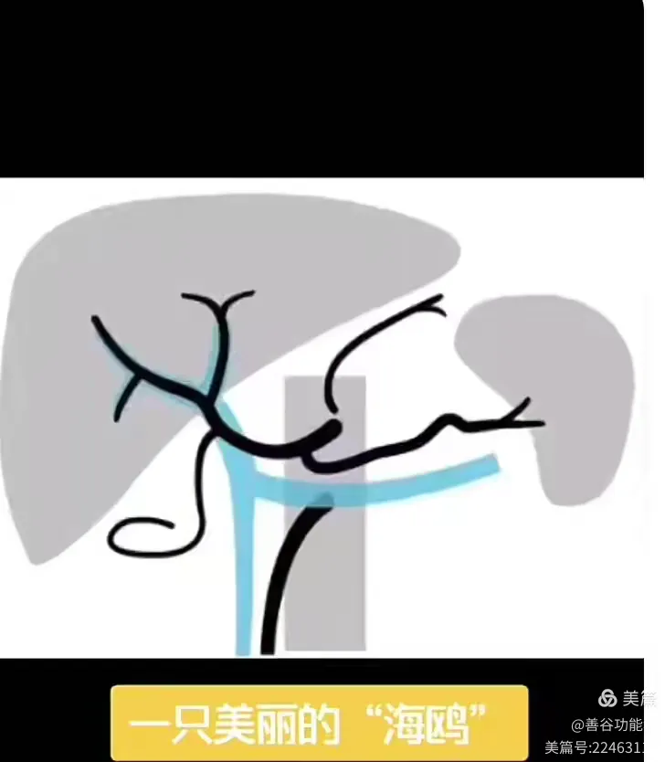 带你解读超声描述之"海鸥征"